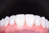 ۹ گام اساسی از مراحل کامپوزیت دندان چیست؟