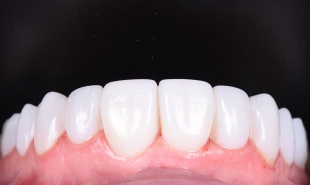۹ گام اساسی از مراحل کامپوزیت دندان چیست؟