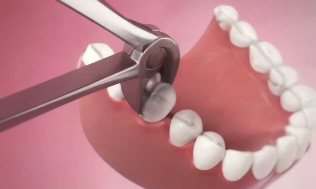 کشیدن دندان ششم کودکان: آیا ضروری است؟