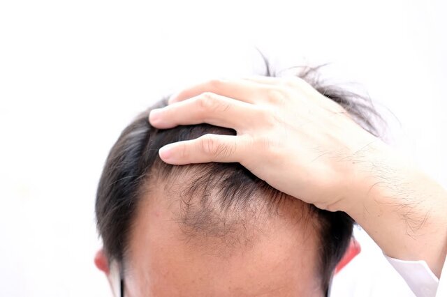 دلایل شایع ریزش مو